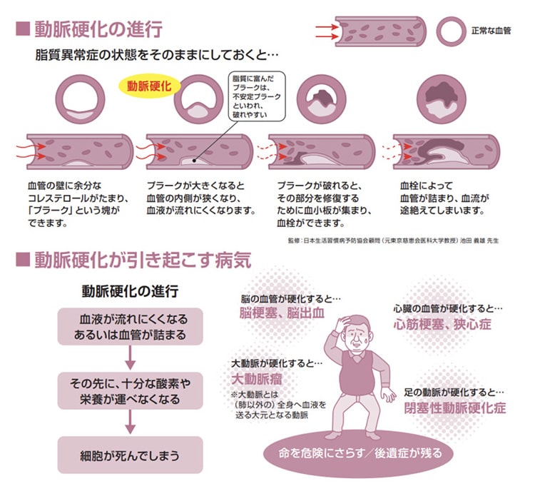 動脈硬化の進行